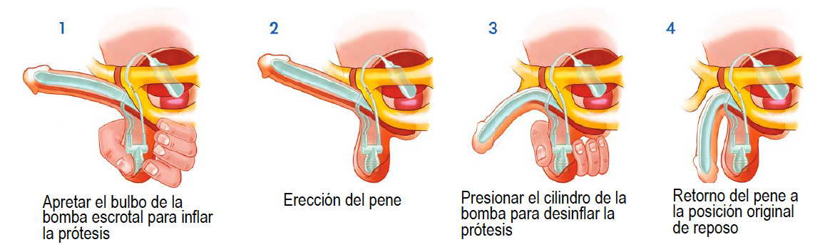implante-pene
